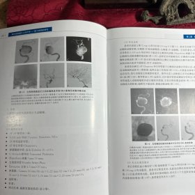 颅内动脉瘤介入治疗学：基于病例的研究