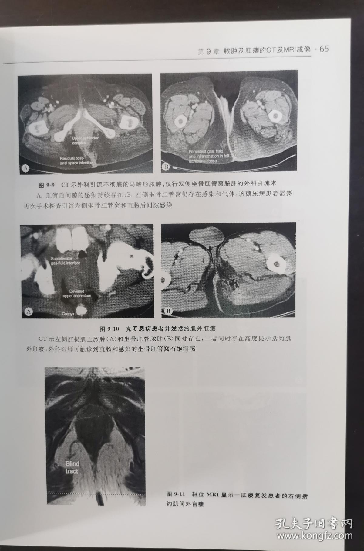 盆底与肛管直肠疾病影像学图谱 （正版书，请买者仔细看图片）