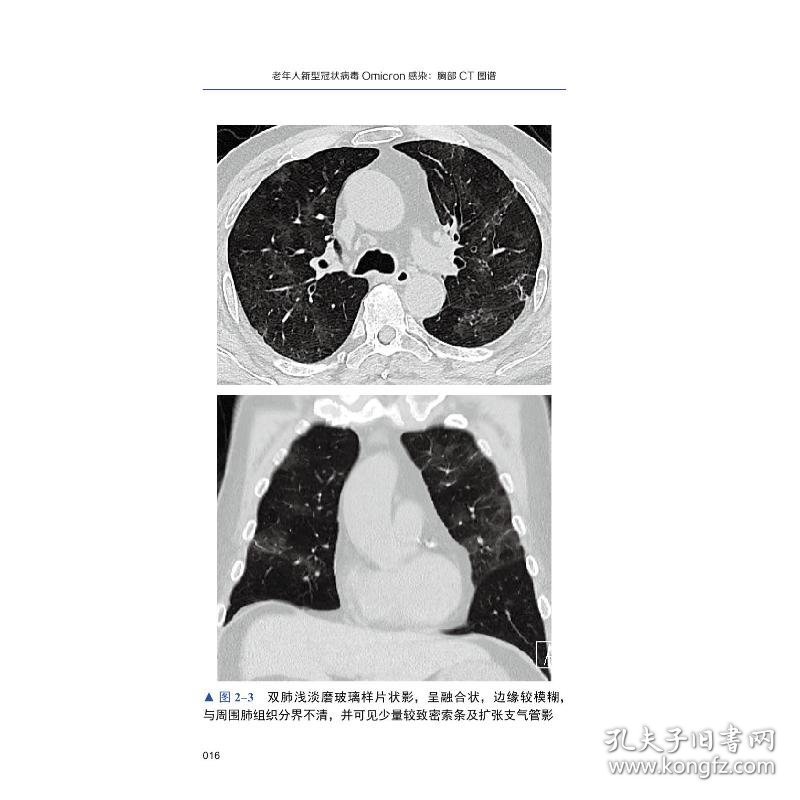 【正版新书】老年人新型冠状病毒Omicron感染胸部CT图谱