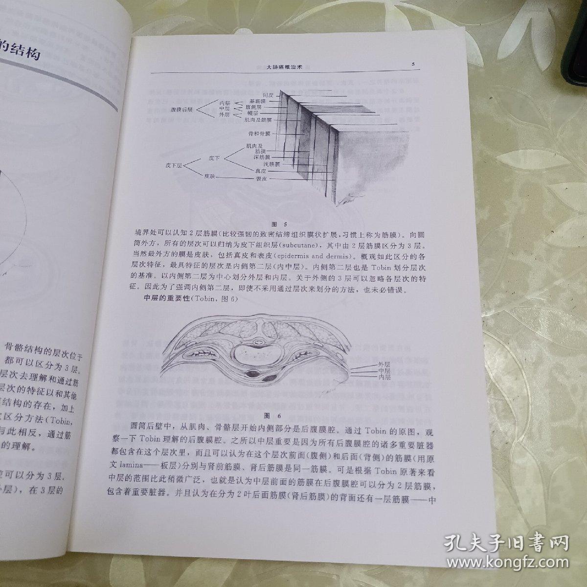 大肠癌根治术