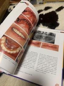 上颌无牙颌美学种植修复系统化指南