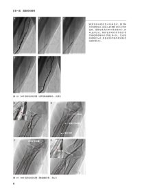 【全新正版，假一罚四】冠心病介入治疗解码9787117326568黄浙勇，葛均波