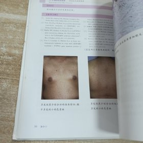 色素增加性皮肤病