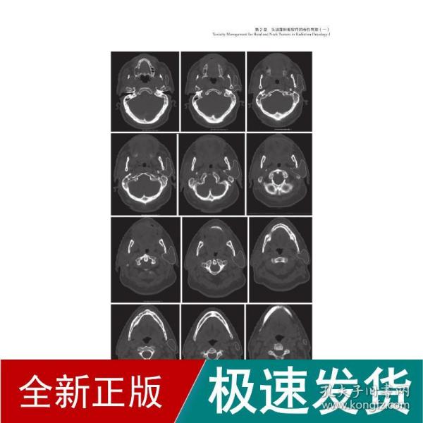 放射肿瘤学急性与晚期毒性的防治：放射肿瘤学中的毒性管理