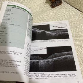 频域光相干断层扫描解读指南（献给资深眼科医生） 16开铜版彩印