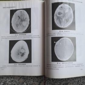 颅脑CT比较诊断与鉴别诊断学