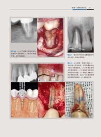 牙髓显微外科治疗技术 （意）阿纳尔多·卡斯泰卢奇（Arnaldo Castellucci）主编 阙克华，屈铁军主译 正版图书