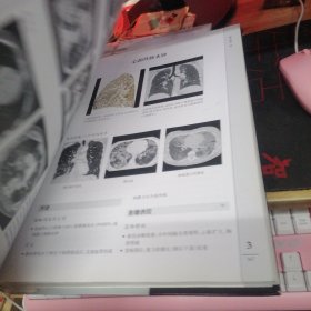 肺部高分辨率CT