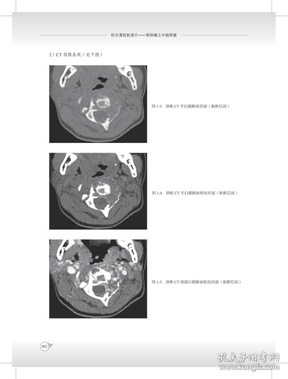 积水潭放射读片——骨肿瘤之中轴骨篇