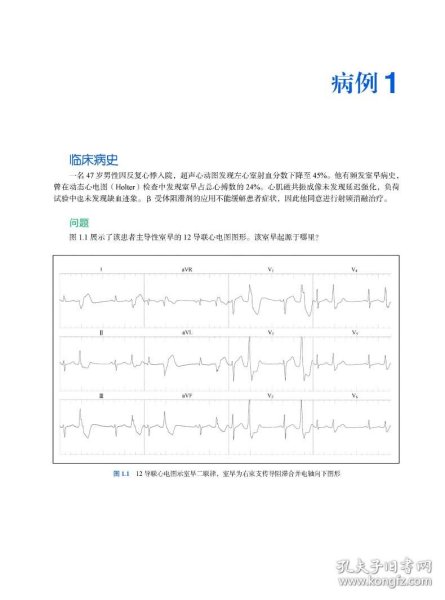 应用心电图定位室性心律失常的起源与消融