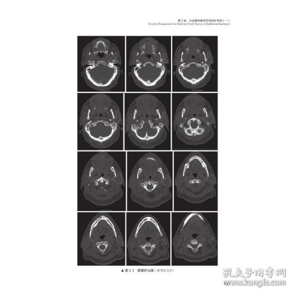 放射肿瘤学急性与晚期毒性的防治：放射肿瘤学中的毒性管理