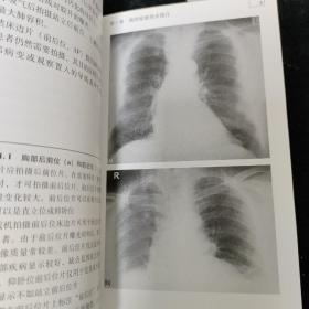 简明胸部X线诊断指南