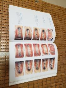 平直弓丝矫治技术——一种新型直丝弓矫治技术的理论与临床