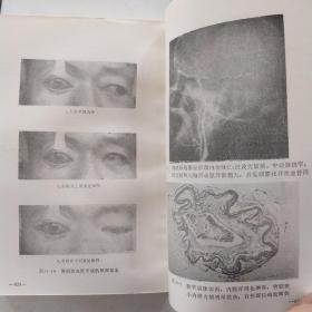 脑血管疾病 第二版(85品小32开1984年2版4印26520册626页41万字)54487