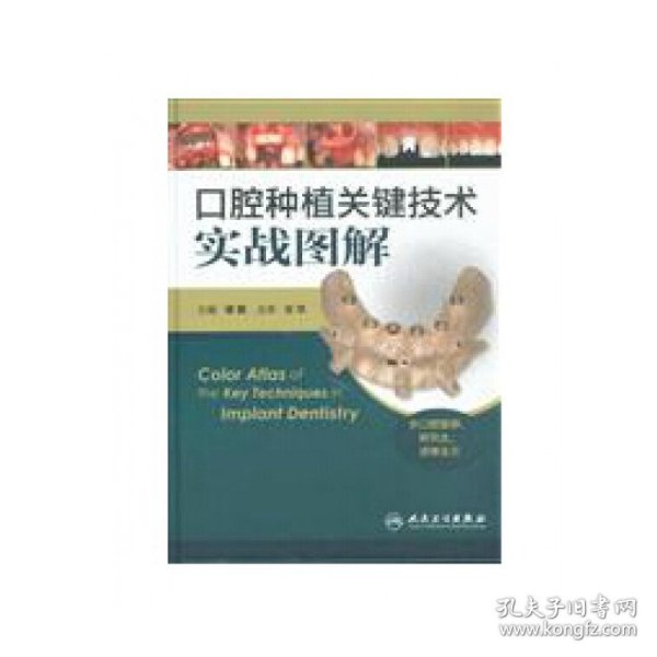 口腔种植关键技术实战图解（供口腔医师、研究生、进修生用）