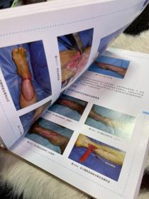 股前外侧穿支皮瓣手术图谱