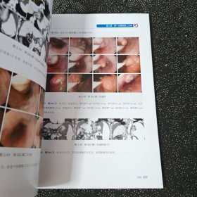 内镜下精准食管胃静脉曲张断流术ESVD