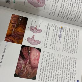 腹腔镜外科局部解剖图谱解剖路径与手术操作。