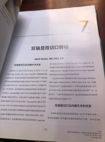 劈核及高阶超乳技术：处理复杂白内障手术的策略与技巧