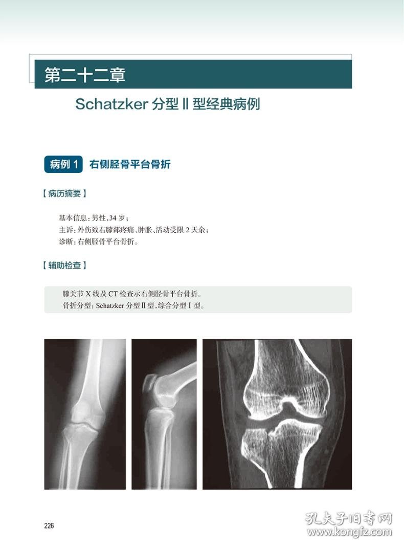 胫骨平台骨折精准微创治疗学 9787117357241