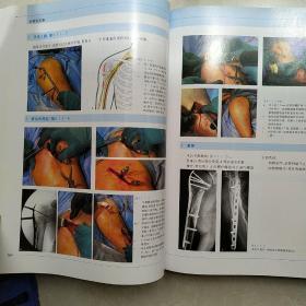 内固定支架：理念及LCP、LISS的临床应用