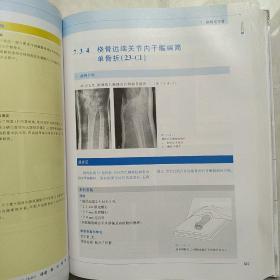 内固定支架：理念及LCP、LISS的临床应用