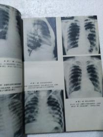 X线诊断学  第一册 胸部