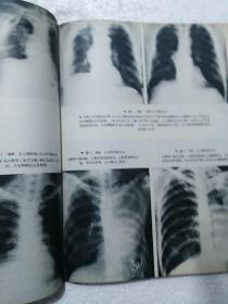 X线诊断学  第一册 胸部