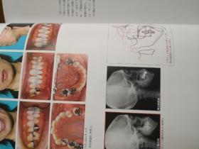 （日文原版）  齿列矫正治疗の失败と再治疗 【牙齿矫正的失败与再治疗，临床案例】