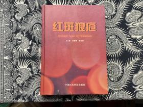 红斑狼疮 一版一印