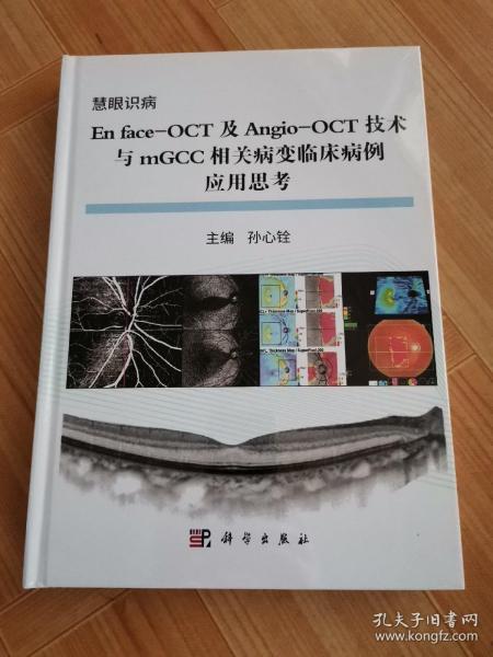 En face-OCT及Angio-OCT技术与mGCC相关病变临床病变应用思考