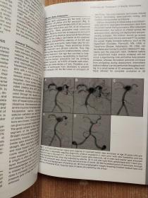 Endovascular Management of Cerebrovascular Disease-脑血管病的血管内治疗