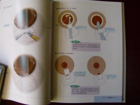 青光眼手术图谱
