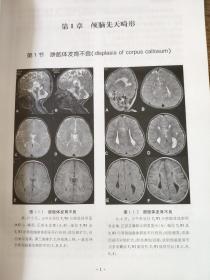 磁共振诊断解析       张新娟 主编        本书共分31个章节，对全身各系统200多个常见疾病的病因病理、影像学表现、MRI表现、相关诊断及鉴别诊断均有详细的描述，每种病例均附以清晰精致的MRI图像。本书以疾病为索引，方便查找；以图像为示例，利于对照；论述简明扼要、图文并茂、实用性强