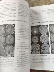 磁共振诊断解析       张新娟 主编        本书共分31个章节，对全身各系统200多个常见疾病的病因病理、影像学表现、MRI表现、相关诊断及鉴别诊断均有详细的描述，每种病例均附以清晰精致的MRI图像。本书以疾病为索引，方便查找；以图像为示例，利于对照；论述简明扼要、图文并茂、实用性强