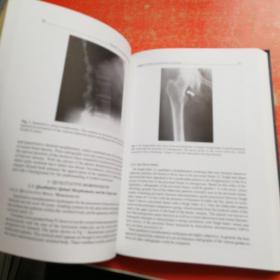 OSTEOPOROSIS骨质疏松（16开精装）英文原版