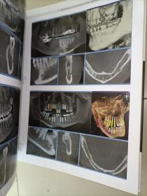 Cone Beam Volumetric Imaging  in Dental, Oral and Maxillofacial Medicine  牙科、口腔和颌面医学基础、诊断和治疗规划中的锥束体积成